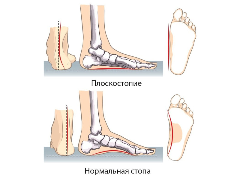 формирование плоскостопия в неправильных кроссовках